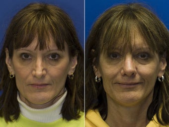 Revision Rhinoplasty