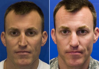 Revision Rhinoplasty with Rib cartilage graft