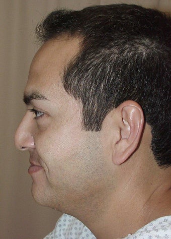 Revision Rhinoplasty