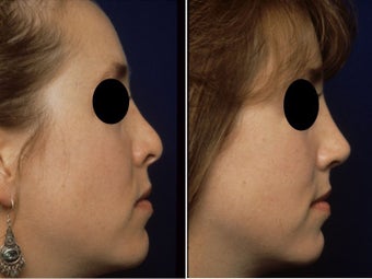 Rhinoplasty Revision