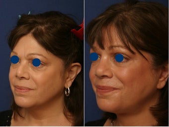 Revision rhinoplasty before and after