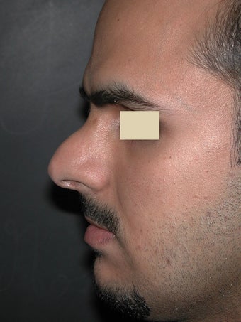 Revision Rhinoplasty