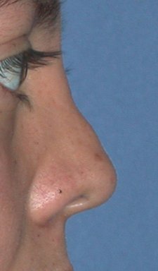 Rhinoplasty - Surgical Revision