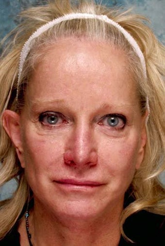 Revising cheek implants and fixing eyelids