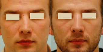 Revision/Corrective Rhinoplasty