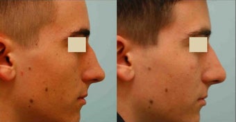 Revision/Corrective Rhinoplasty