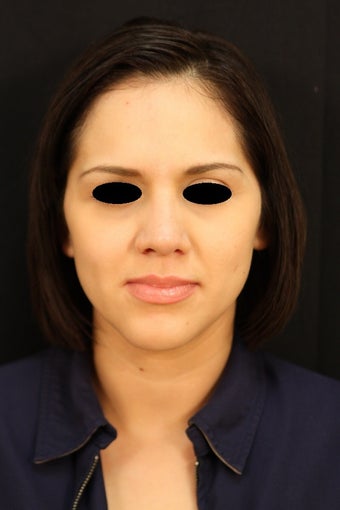 Revision Rhinoplasty with septal perforation repair