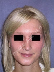Rhinoplasty