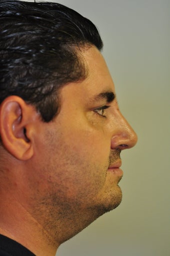 Rhinoplasty