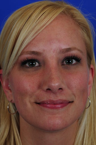 Revision Rhinoplasty