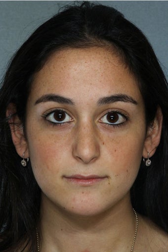 Rhinoplasty