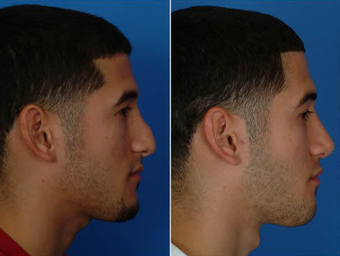 Nose Surgery (Revision Rhinoplasty)