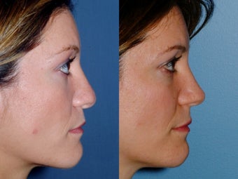 Revision rhinoplasty