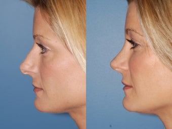 Revision rhinoplasty