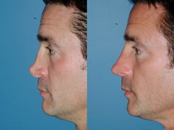 Revision rhinoplasty