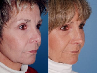 Revision rhinoplasty