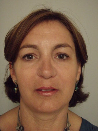 4th Revision Rhinoplasty