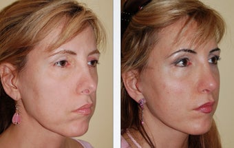 Revision Rhinoplasty