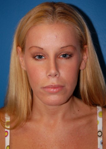 Revision Rhinoplasty