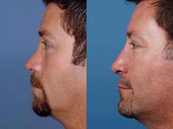 Revision rhinoplasty