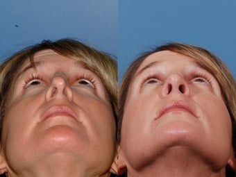 Revision rhinoplasty