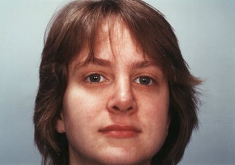 Revision Rhinoplasty