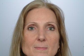 Revision Rhinoplasty