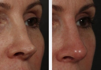 Revision Rhinoplasty