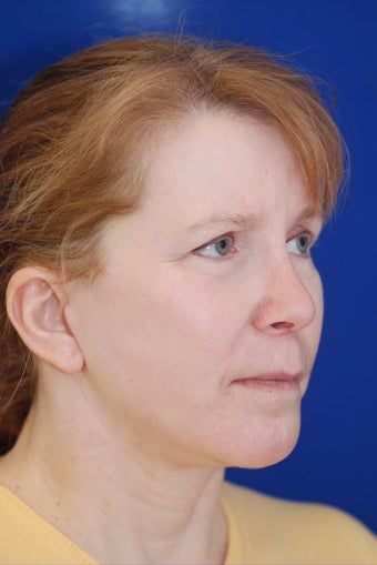 Facelift and Revision Rhinoplasty