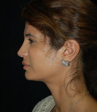 Revision Rhinoplasty