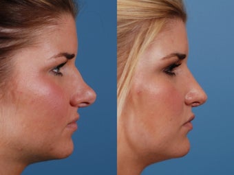 Revision rhinoplasty