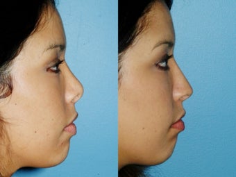 Revision rhinoplasty