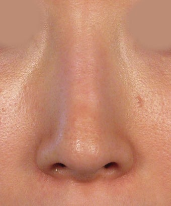 Revision Rhinoplasty