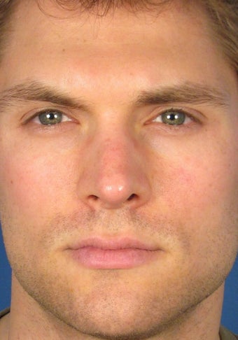 Revision Rhinoplasty