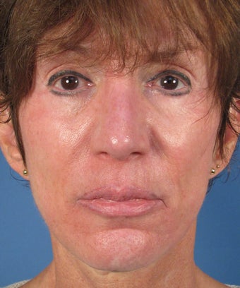Revision Rhinoplasty