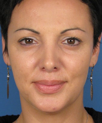 Revision Rhinoplasty