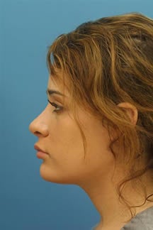 Revision Rhinoplasty
