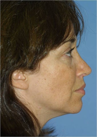 Revision Rhinoplasty