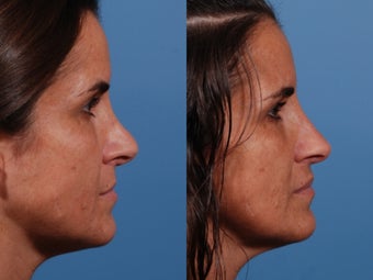 Revision rhinoplasty