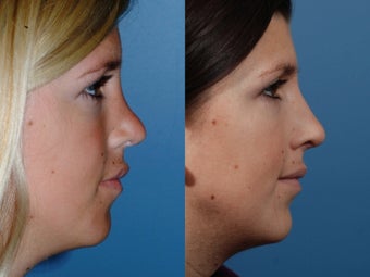 Revision rhinoplasty