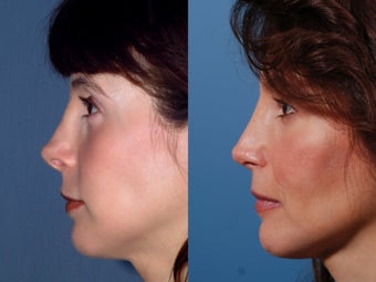 Revision rhinoplasty
