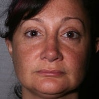 Revision Rhinoplasty