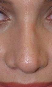 Revision Rhinoplasty