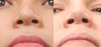 Revision Rhinoplasty