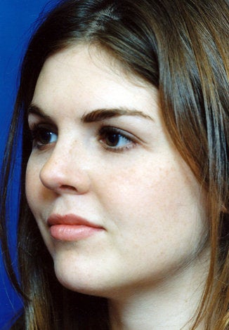 Revision Rhinoplasty