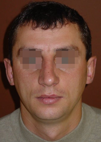 Crooked nose correction