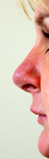 Revision Rhinoplasty