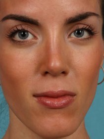 Revision Rhinoplasty