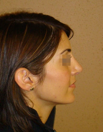 Rhinoplasty/nose job surgery