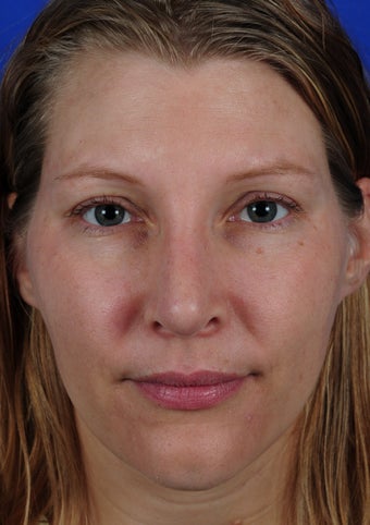 Revision Rhinoplasty